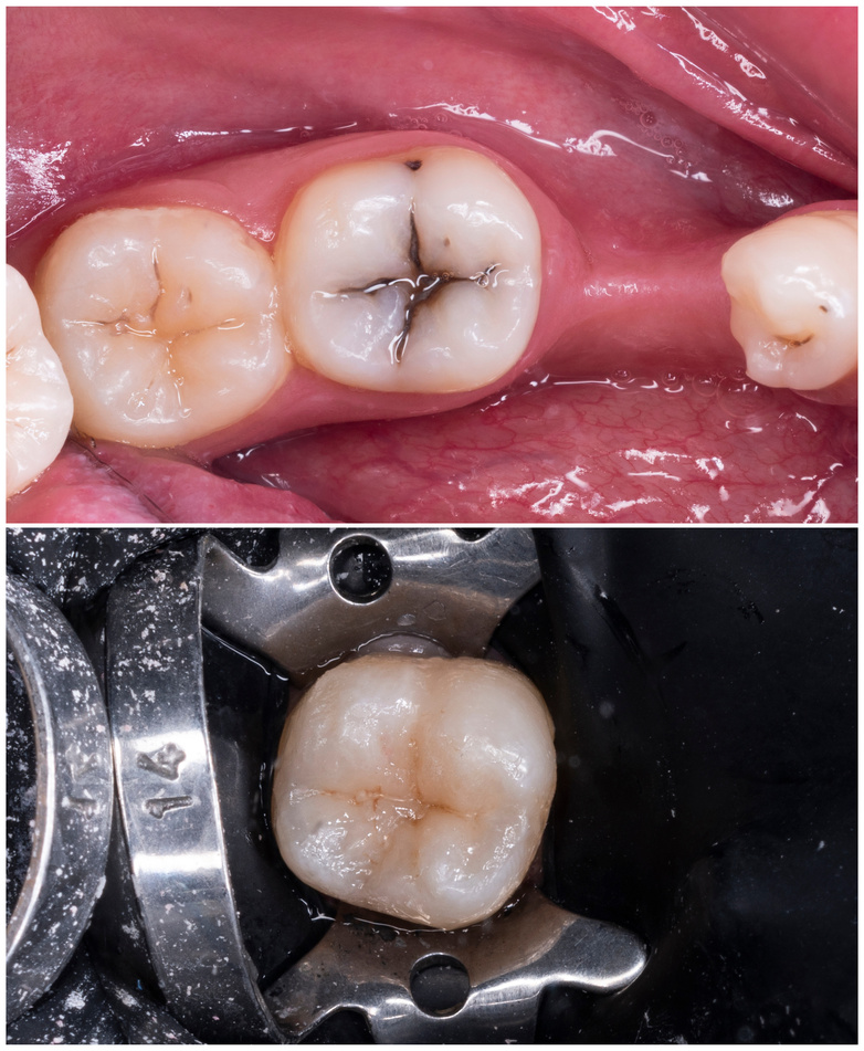 before and after picture for dental composite restoration and caries treatment