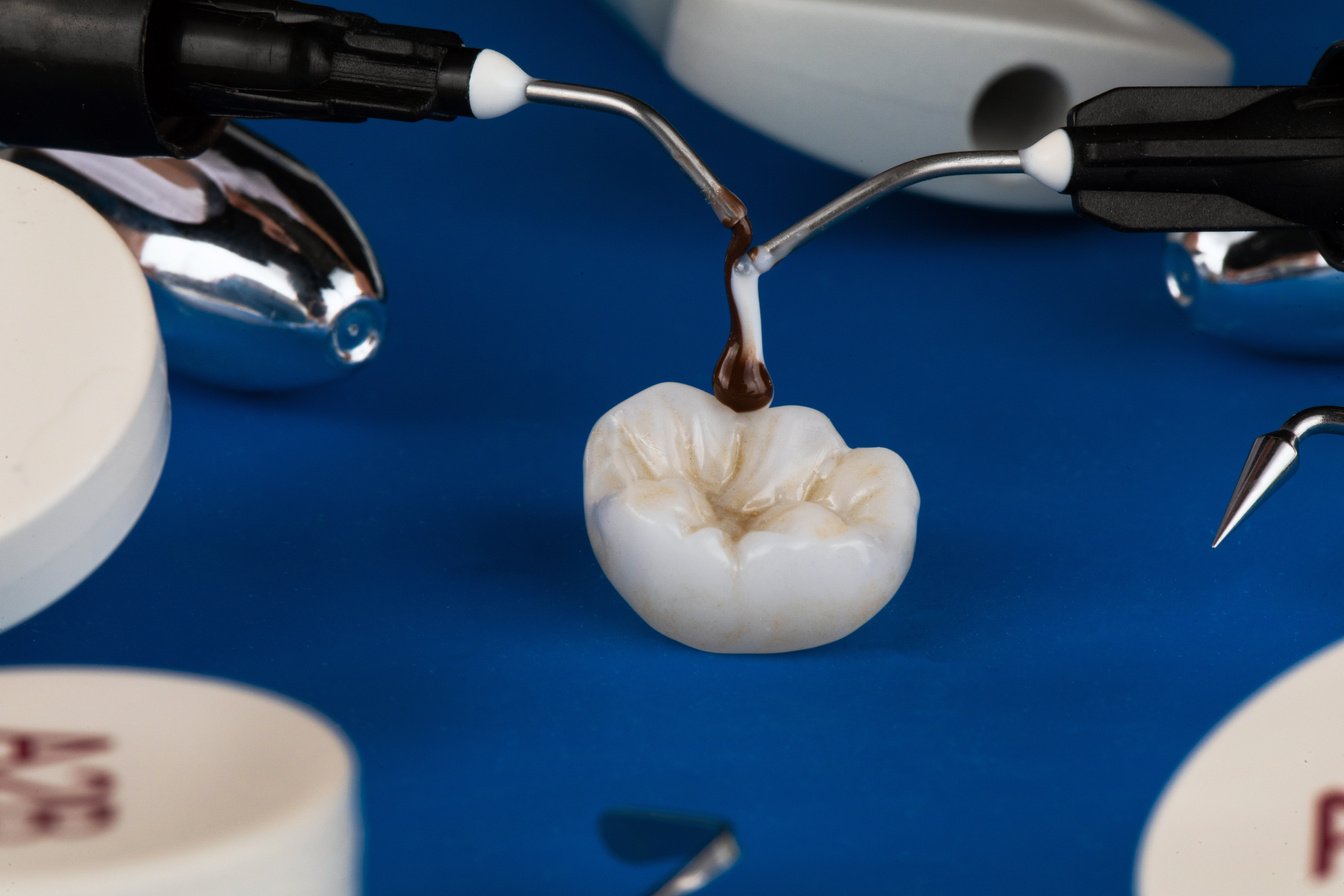 Composition of Dental Crown Inlays and Polymer Materials from Sp